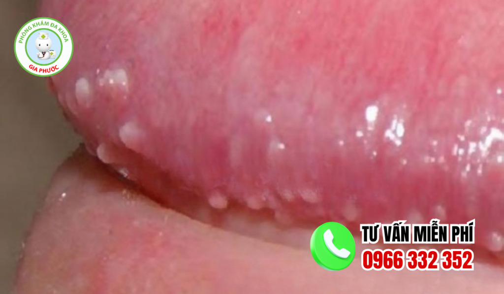 Mụn gai sinh dục nam giới