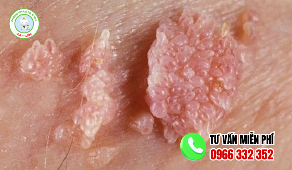 Hình ảnh mụn gai sinh dục nữ chi tiết