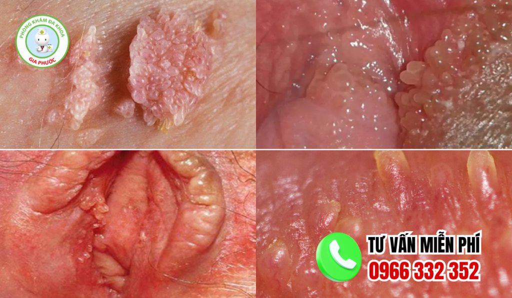 Hình ảnh mụn gai sinh dục nữ chi tiết