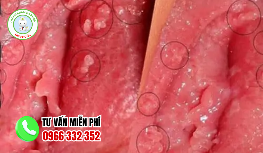 Mụn gai sinh dục nữ giới