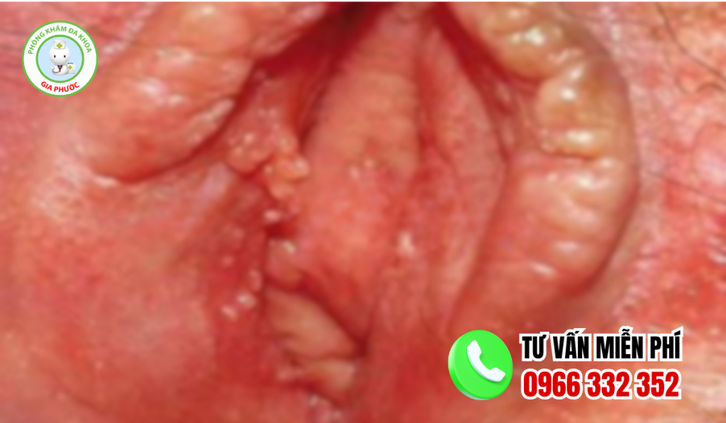 Hình ảnh mụn gai sinh dục nữ chi tiết