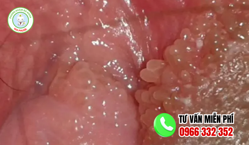 Hình ảnh mụn gai sinh dục nữ chi tiết