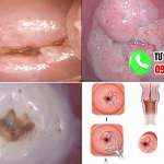 20 Hình Ảnh Sau Khi Đốt Viêm Lộ Tuyến Cổ Tử Cung Và Tiến Trình Phục Hồi (2026) 8 Hình ảnh sau khi đốt viêm lộ tuyến