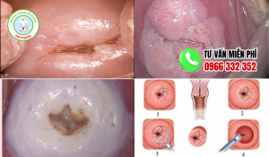 Hình ảnh sau khi đốt viêm lộ tuyến