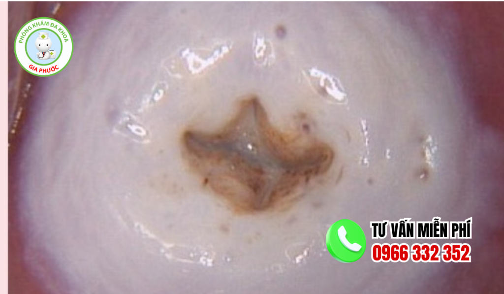 Hình ảnh sau khi đốt viêm lộ tuyến