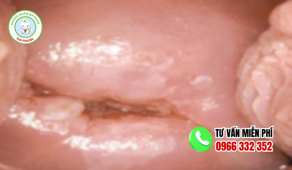 Hình ảnh sau khi đốt viêm lộ tuyến
