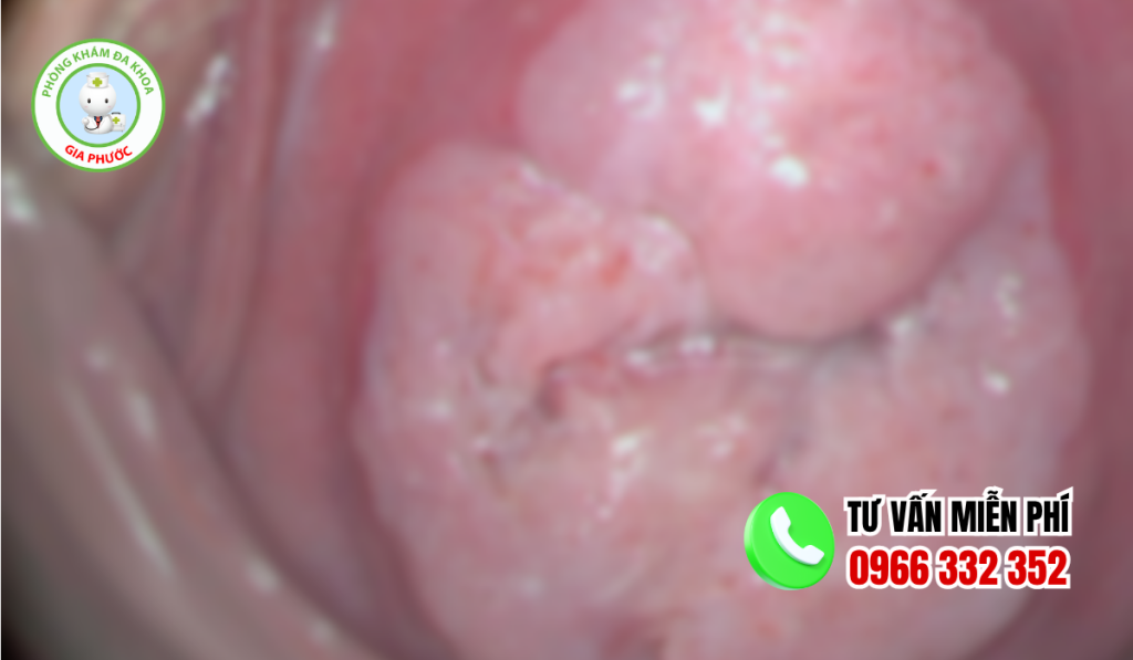 Hình ảnh sau khi đốt viêm lộ tuyến