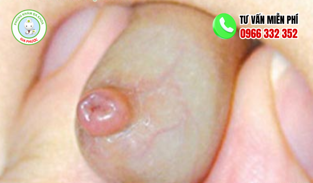Hình ảnh trẻ hẹp bao quy đầu
