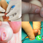 Hình ảnh trẻ bị hẹp bao quy đầu