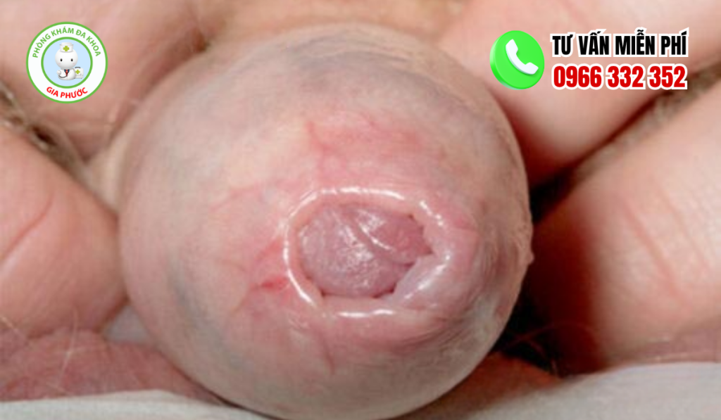Hình ảnh trẻ hẹp bao quy đầu