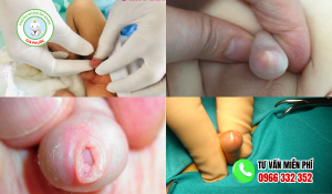 Hình ảnh trẻ bị hẹp bao quy đầu