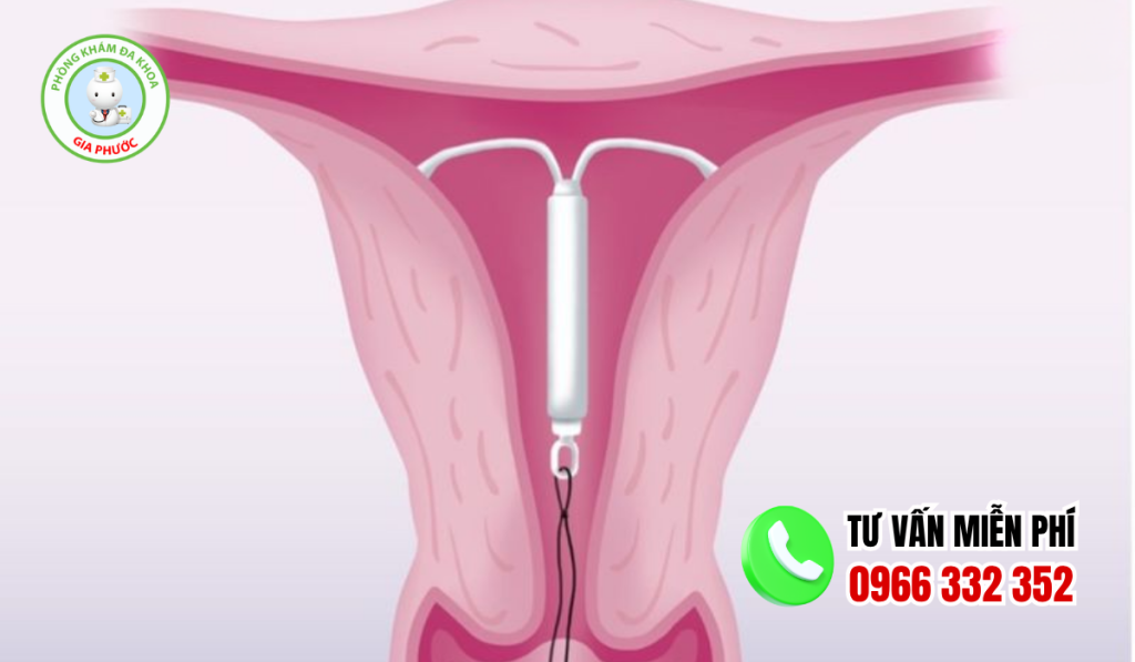 Ưu Và Nhược Điểm Khi Đặt Vòng Tránh Thai