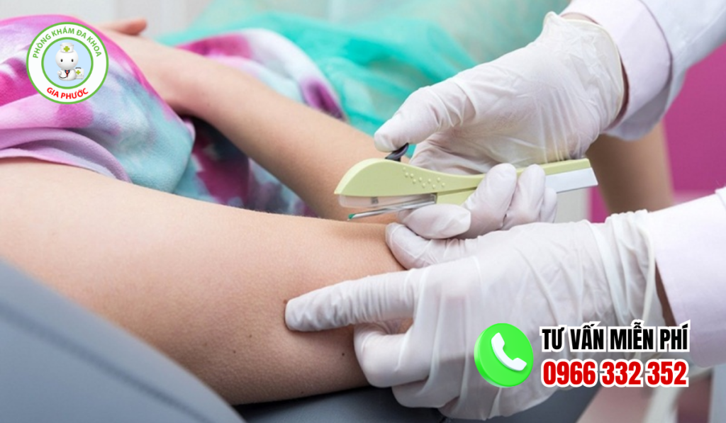 20 Lợi Ích Và Tác Dụng Phụ Khi Cấy Que Tránh Thai 2026 3 Lợi ích và tác dụng phụ khi cấy que tránh thai