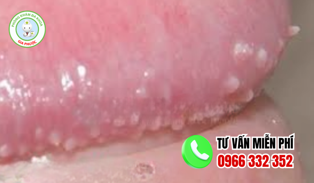 Gai Sinh Dục Nam Là Gì? Hình Ảnh, Nguyên Nhân Và Cách Trị (2026) 1 Gai sinh dục nam là gì