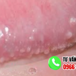 Gai sinh dục nam là gì