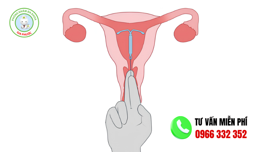 Ưu Và Nhược Điểm Khi Đặt Vòng Tránh Thai