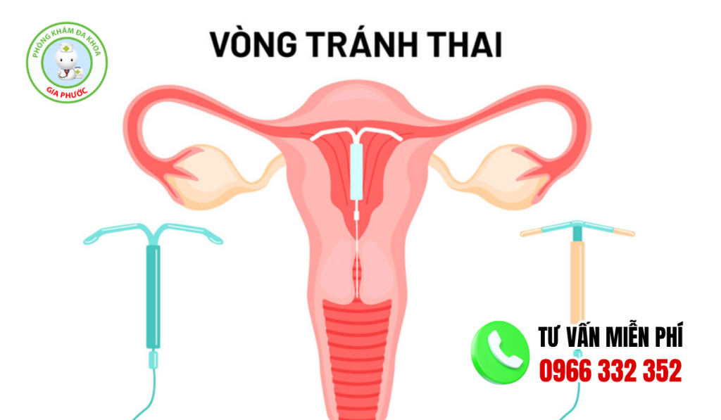 Ưu Và Nhược Điểm Khi Đặt Vòng Tránh Thai