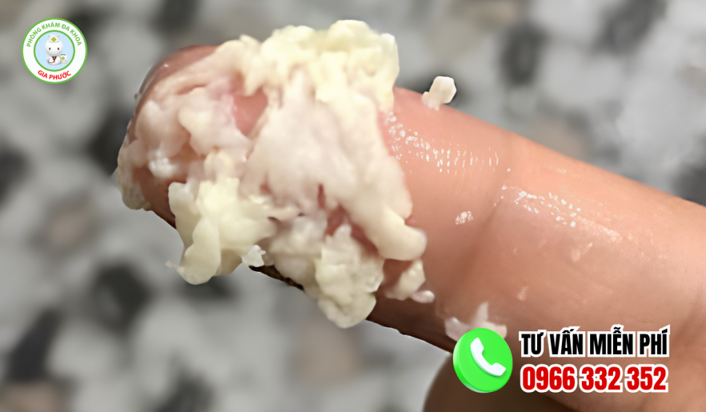 Vùng kín bị nấm trắng: Nguyên nhân dấu hiệu và cách điều trị