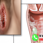 Vùng kín bị nấm trắng: Nguyên nhân dấu hiệu và cách điều trị