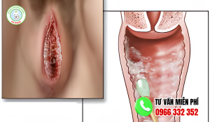 Vùng kín bị nấm trắng: Nguyên nhân dấu hiệu và cách điều trị