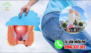 Xì hơi nhiều sau mỗ trĩ