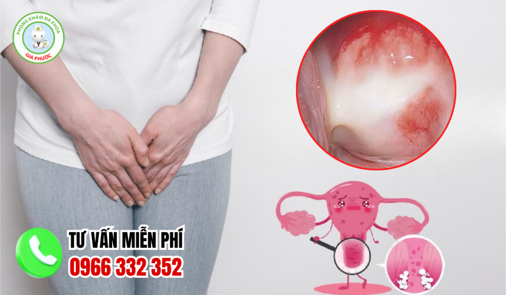 Hình Ảnh Viêm Phụ Khoa Ở Nữ Giới Và Cách Điều Trị Dứt Điểm 2 Bệnh Viêm Phụ Khoa Là Gì?