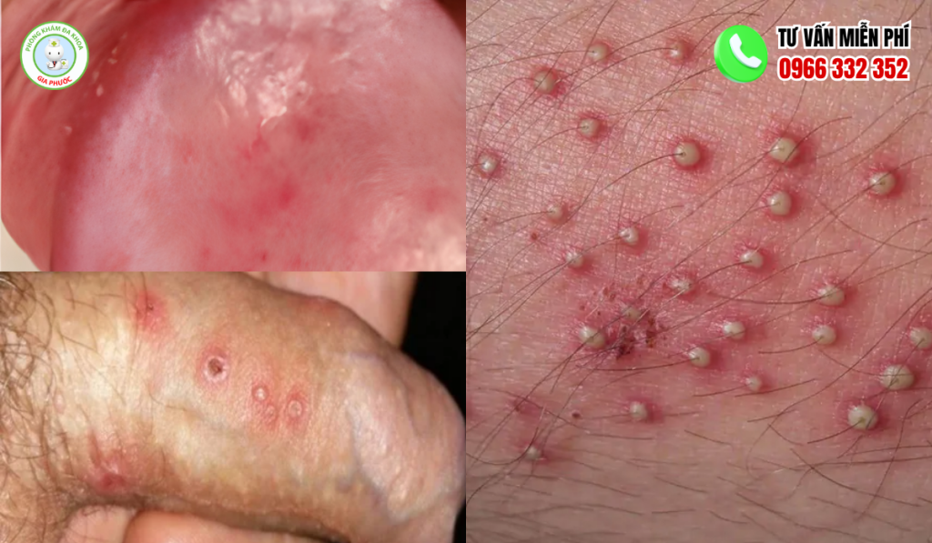 Hình Ảnh Nổi Mụn Ở Vùng Kín Nam Và Cách Điều Trị An Toàn 4 hình ảnh nổi mụn ở vùng kín nam