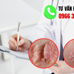 Chi phí điều trị sùi mào gà bao nhiêu tiền