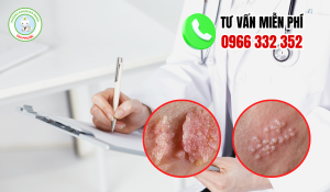 Chi phí điều trị sùi mào gà bao nhiêu tiền