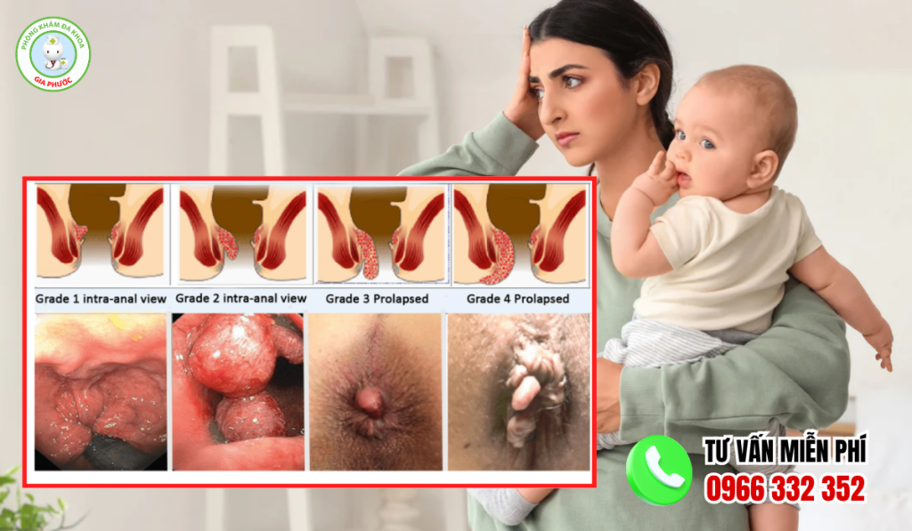 hình ảnh bệnh trĩ sau sinh