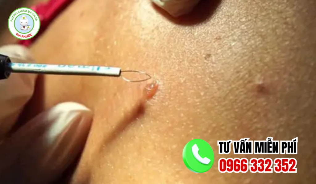 Địa chỉ chữa sùi mào gà an giang