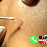 Địa chỉ chữa sùi mào gà an giang