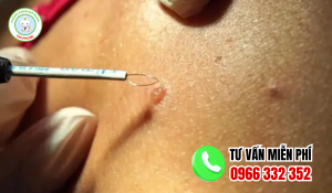 Địa chỉ chữa sùi mào gà an giang