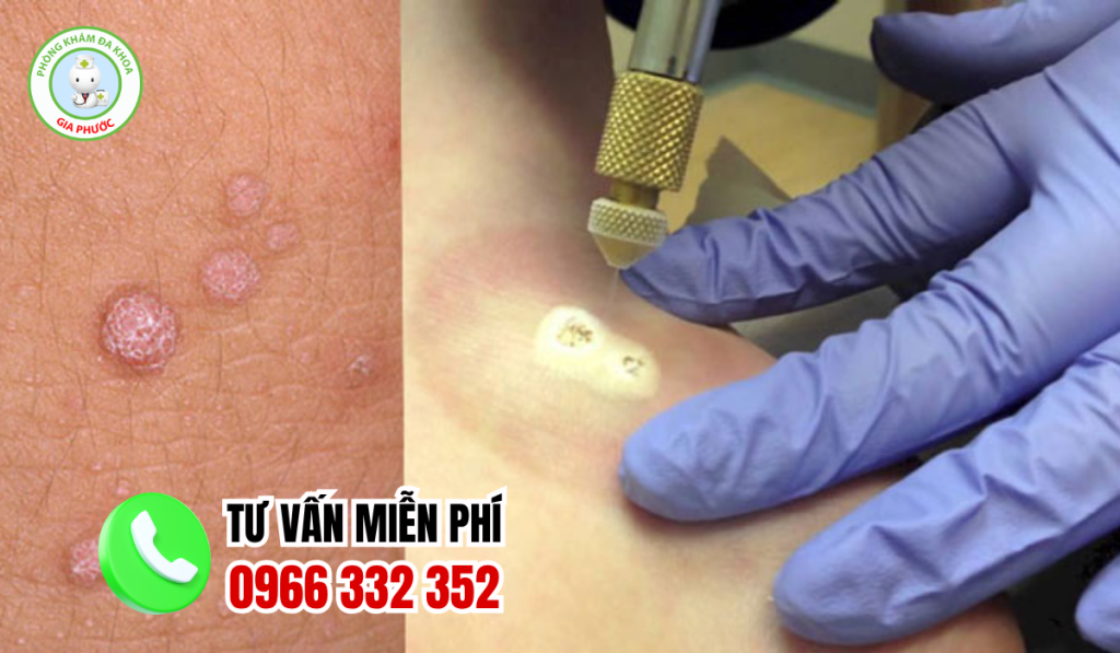 Địa chỉ chữa sùi mào gà bạc liêu
