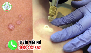 Địa chỉ chữa sùi mào gà bạc liêu