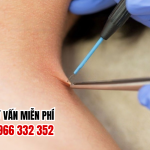 Địa chỉ chữa sùi mào gà cà mau
