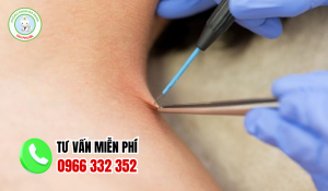 Địa chỉ chữa sùi mào gà cà mau