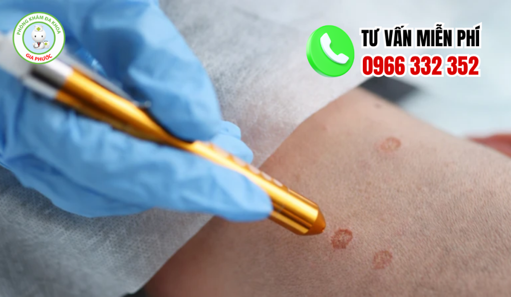 Địa chỉ chữa sùi mào gà đồng tháp