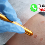 Địa chỉ chữa sùi mào gà đồng tháp