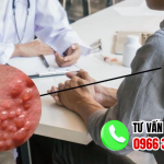 Địa chỉ chữa sùi mào gà sóc trăng