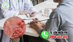 Địa chỉ chữa sùi mào gà sóc trăng