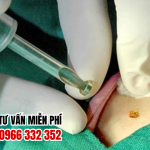 Địa chỉ chữa sùi mào gà trà vinh