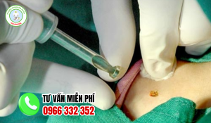 Địa chỉ chữa sùi mào gà trà vinh
