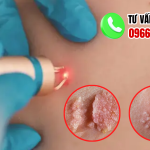 Top 5 Địa Chỉ Điều Trị Sùi Mào Gà Vĩnh Long Uy Tín 2026 53 Địa chỉ chữa sùi mào gà vĩnh long
