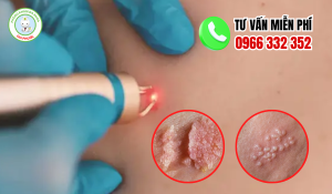 Địa chỉ chữa sùi mào gà vĩnh long