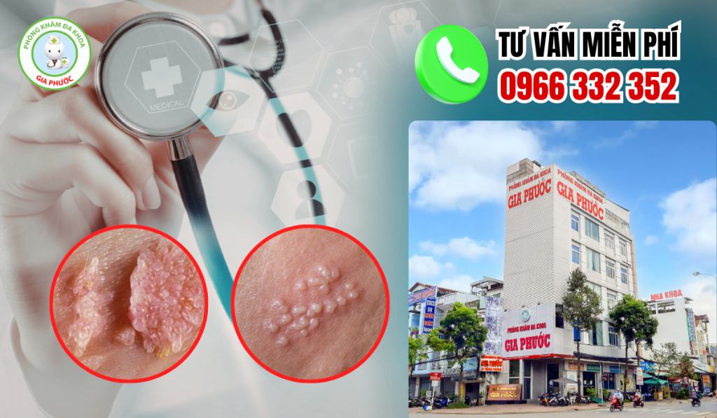 Địa Chỉ Điều Trị Sùi Mào Gà Hậu Giang Uy Tín 2026 1 Địa chỉ điều trị sùi mào gà hậu giang uy tín