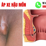 hình ảnh áp xe hậu môn