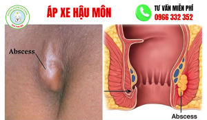hình ảnh áp xe hậu môn
