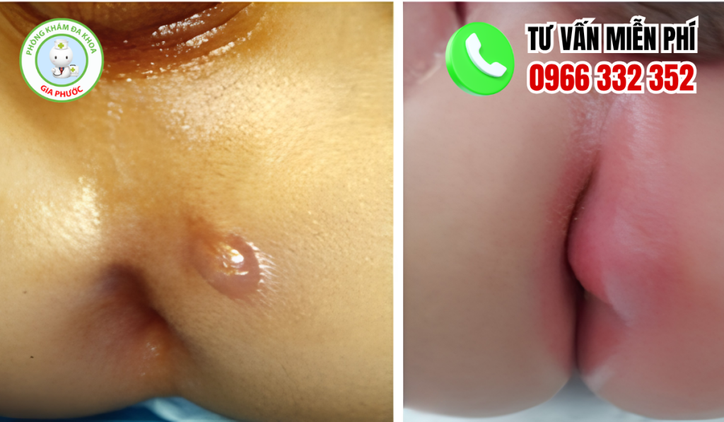 Hình Ảnh Áp Xe Hậu Môn Người Lớn, Trẻ Nhỏ Và Cách Điều Trị 2 Hình ảnh áp xe hậu môn