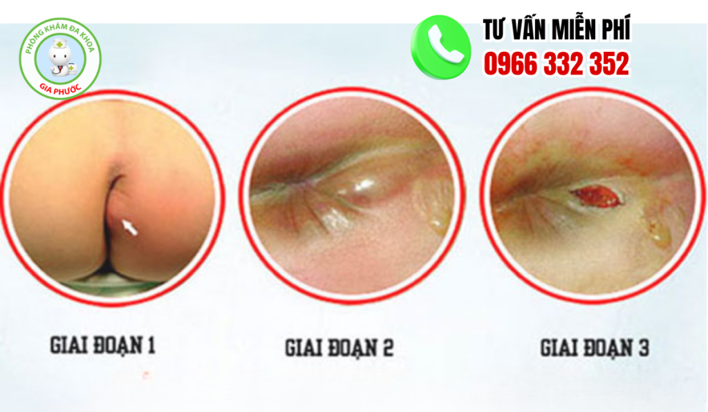 Hình Ảnh Áp Xe Hậu Môn Người Lớn, Trẻ Nhỏ Và Cách Điều Trị 3 hình ảnh áp xe hậu môn